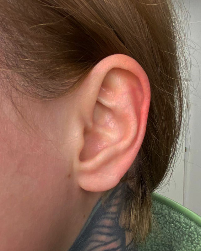 Wygląd 6 miesięcy po wykonaniu rekonstrukcji płatka ucha.